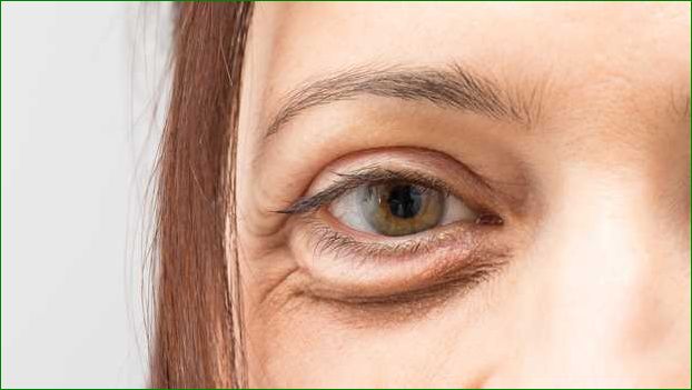 Pludselig hævelse under øjet Årsager symptomer og behandling
